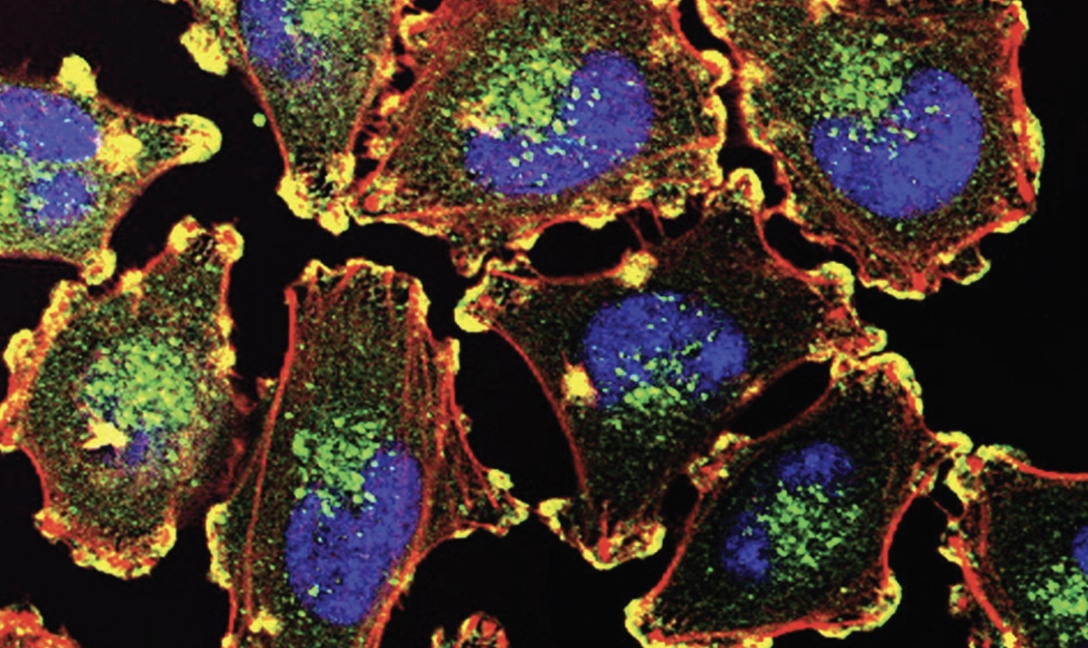 Photo credit: Metastatic melanoma cells, National Cancer Institute, Julio C. Valencia