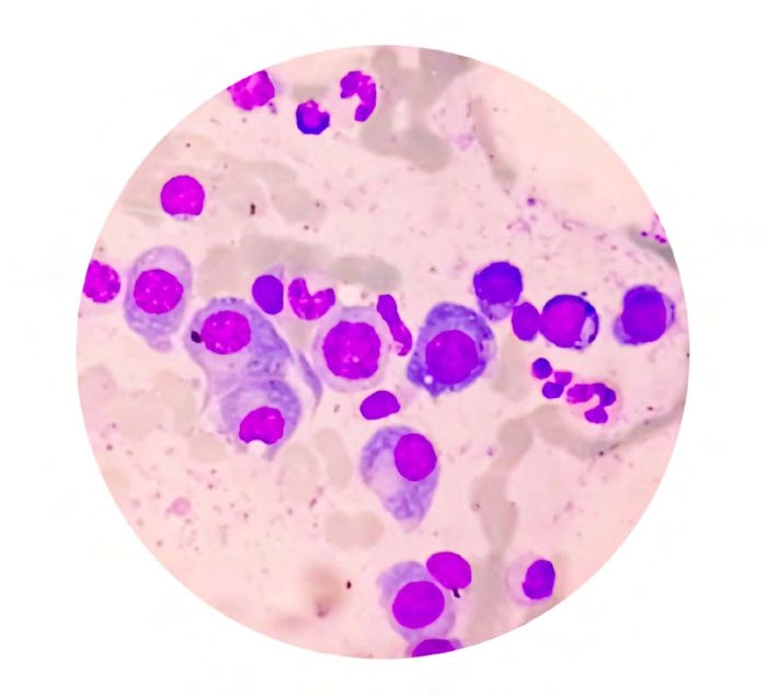 Microscopic view of bone marrow slide, showing multiple myeloma
